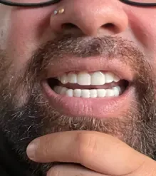 Shiny Smile Veneers 5