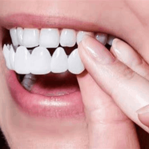 Shiny Smile Veneers 9